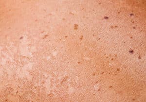Intermountain Aesthetics MD Spa Ogden Utah Laser Spot Removal