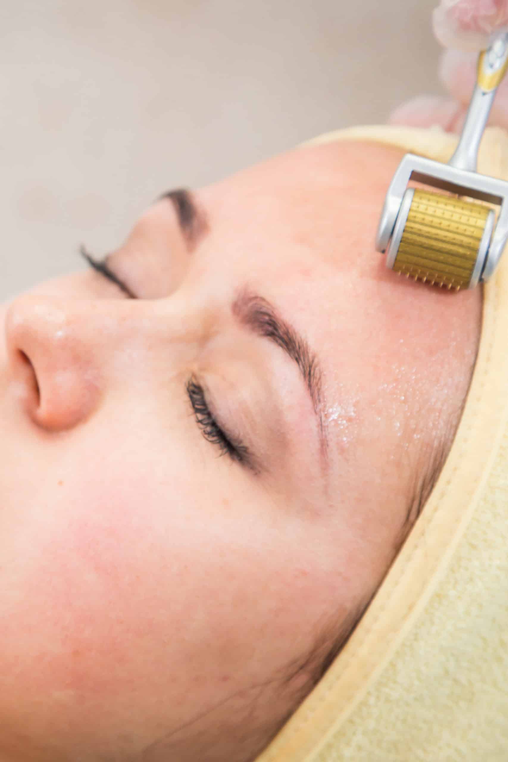 microneedling