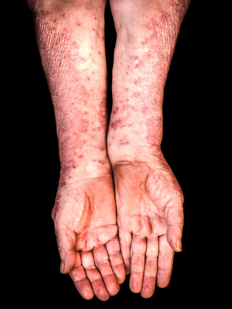 Psoriasis Psoriasis