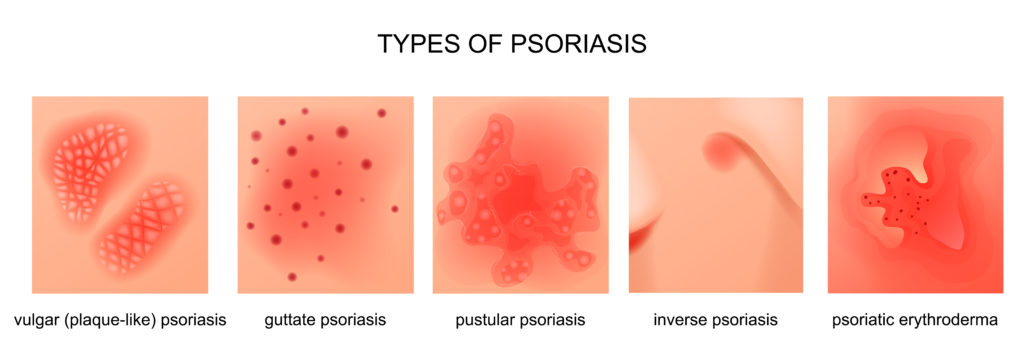 Psoriasis Psoriasis